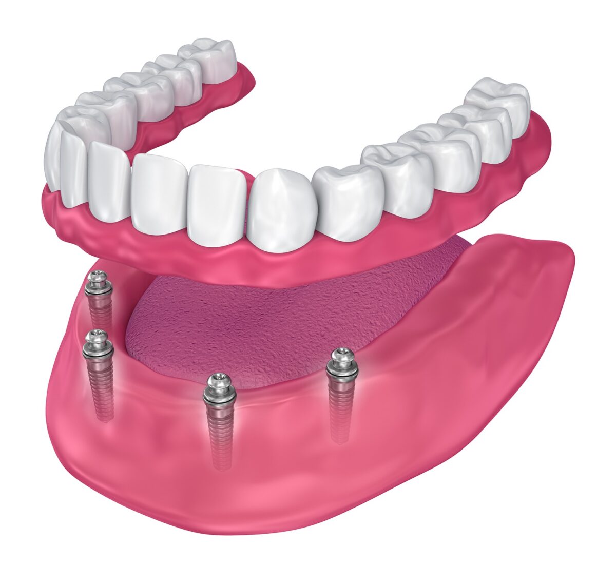 illustration of all-on-4 dental implants